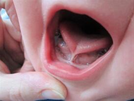 “Dil bağı bebeklerde ciddi gelişim sorunlarına yol açabiliyor”